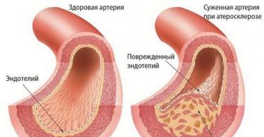 Болезнь недостаточного кровоснабжения сердца